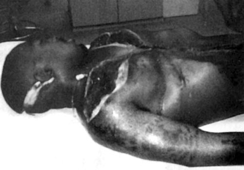 Tupac Shakur Autopsy Photo